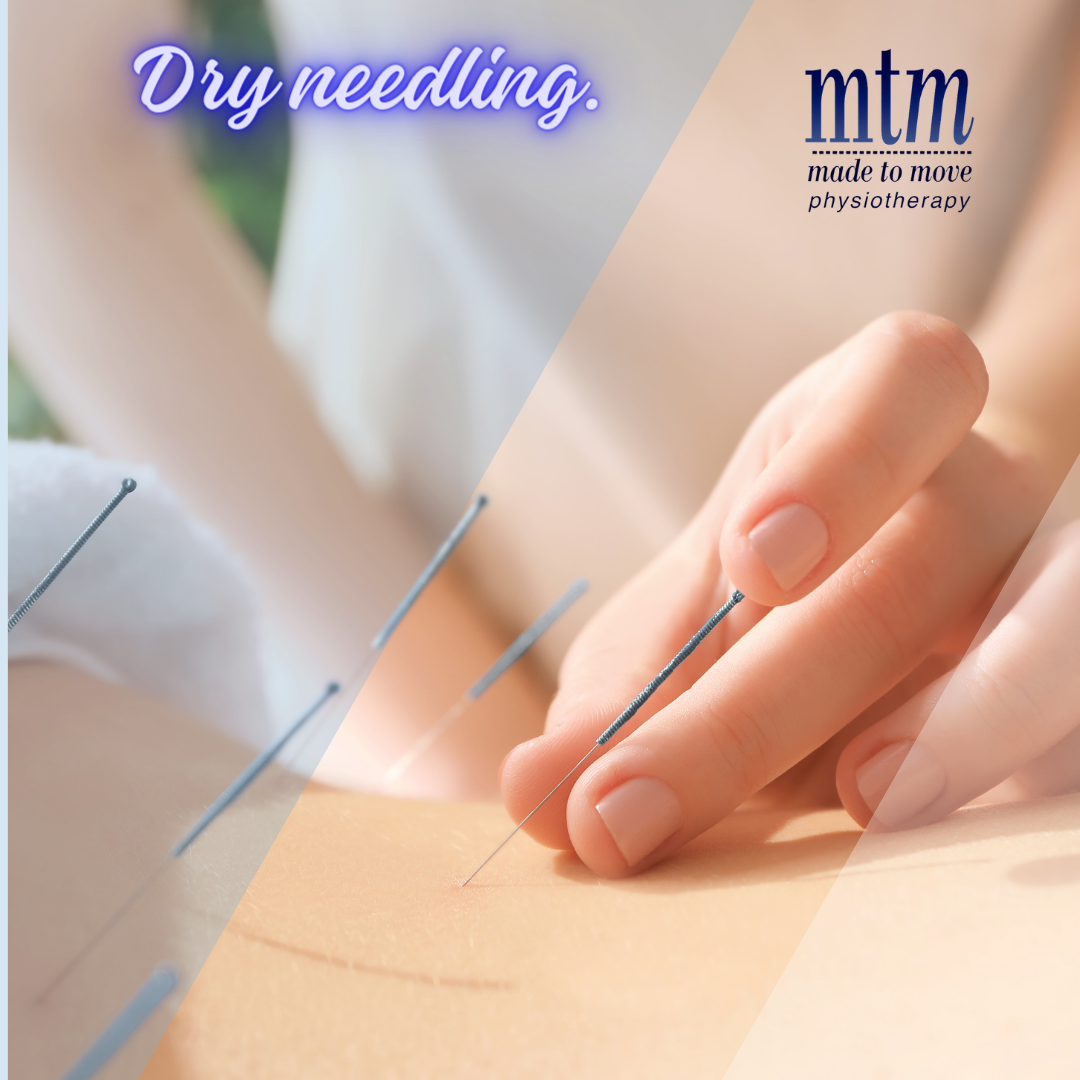 Dry Needling and Accupuncture Dry Needling and Accupuncture